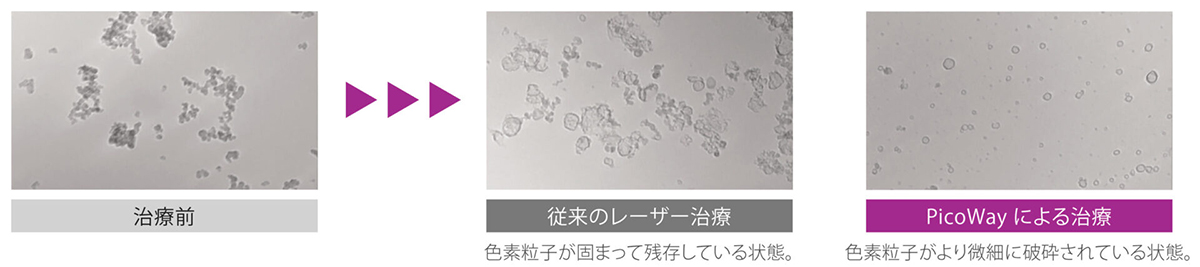 ピコ秒レーザーによる高い効果