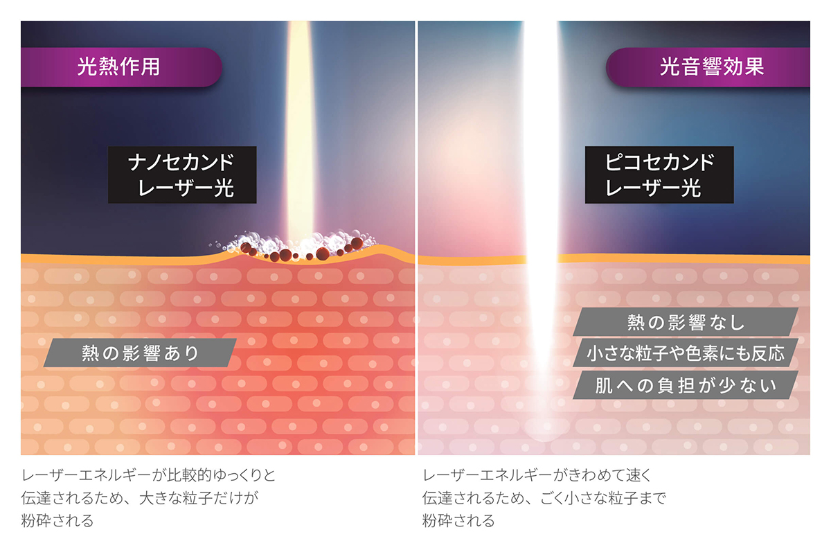 肌への負担を抑えたやさしい治療